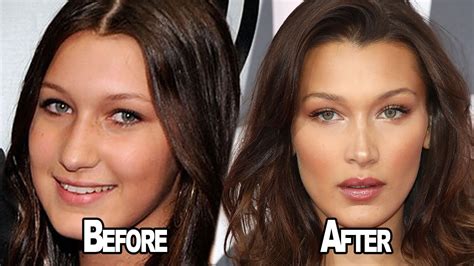 Bella Hadid plastic surgery: Before and after 